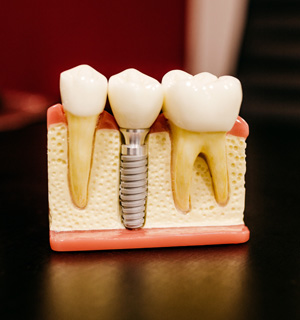 Implant